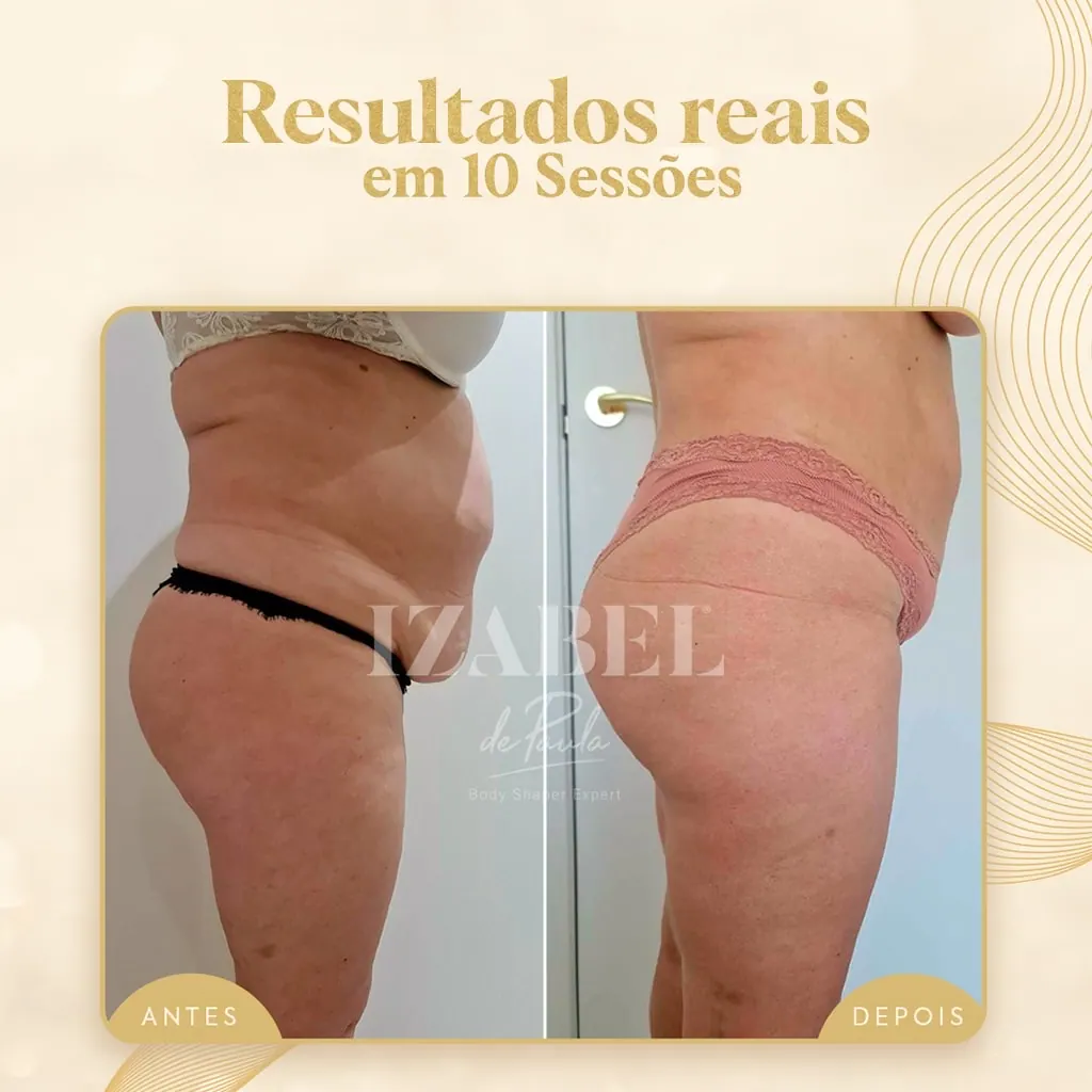 Antes e depois — 10 sessões · lateral — método IZB de modelagem corporal