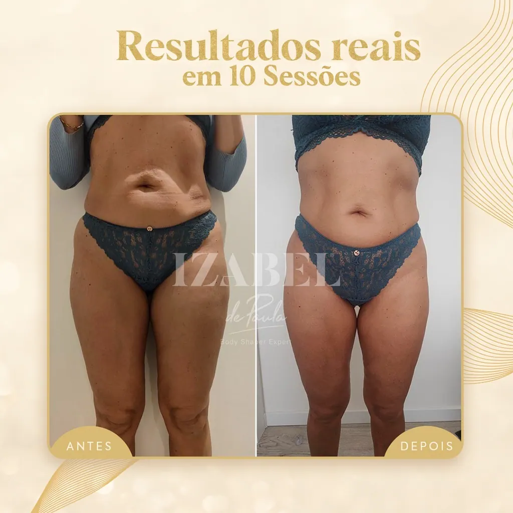 Antes e depois — 10 sessões · frontal — método IZB de modelagem corporal