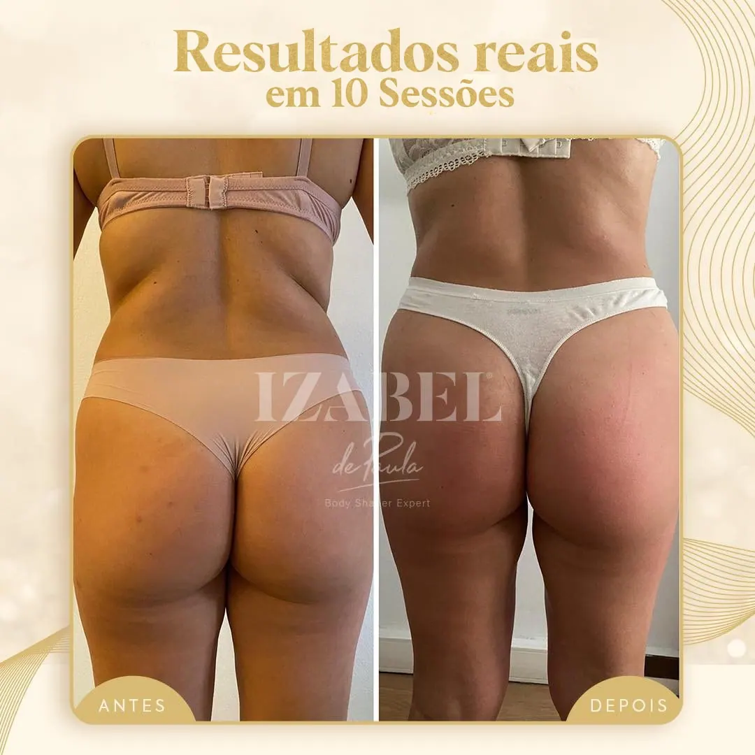 Antes e depois — 10 sessões · posterior — método IZB de modelagem corporal