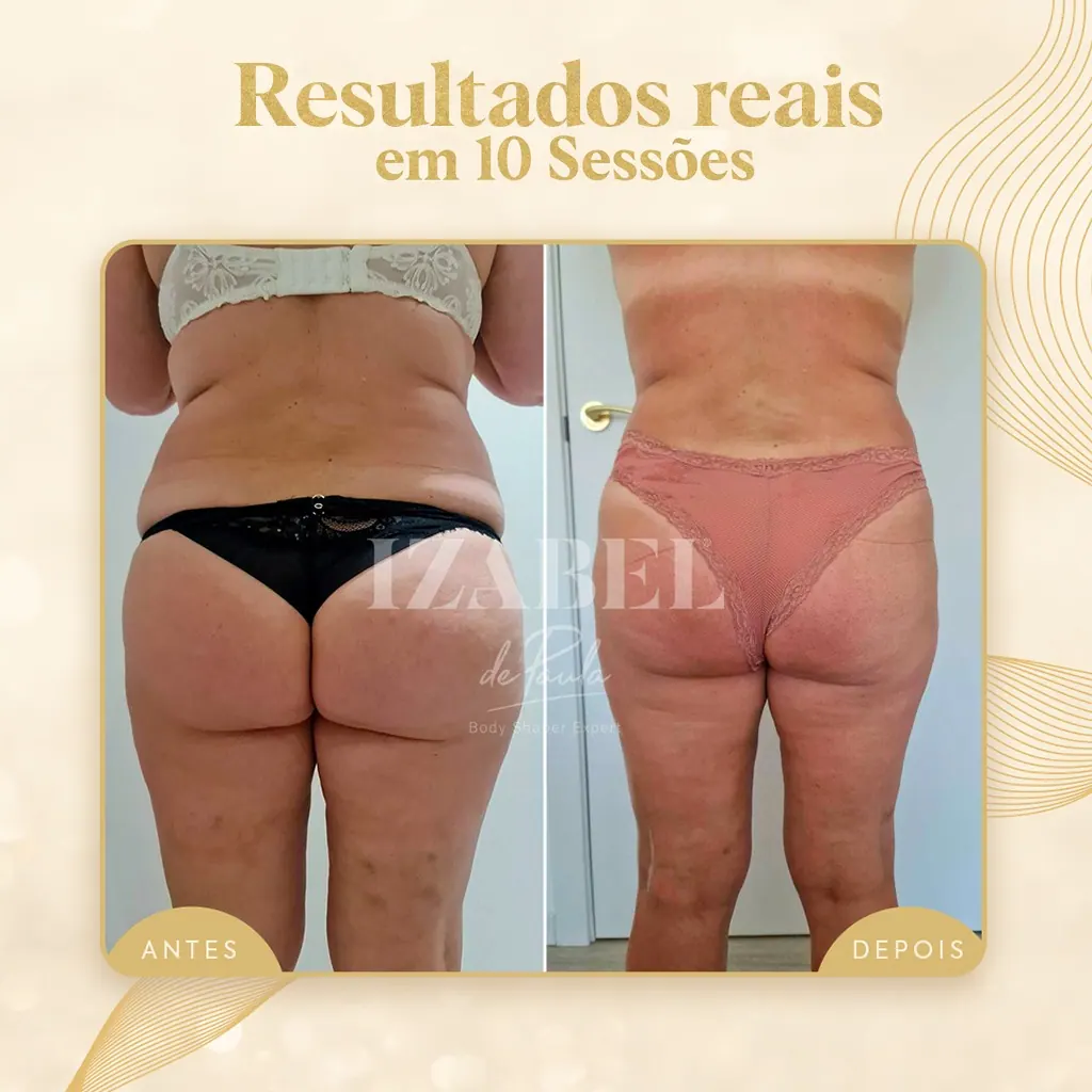 Antes e depois — 10 sessões · posterior — método IZB de modelagem corporal